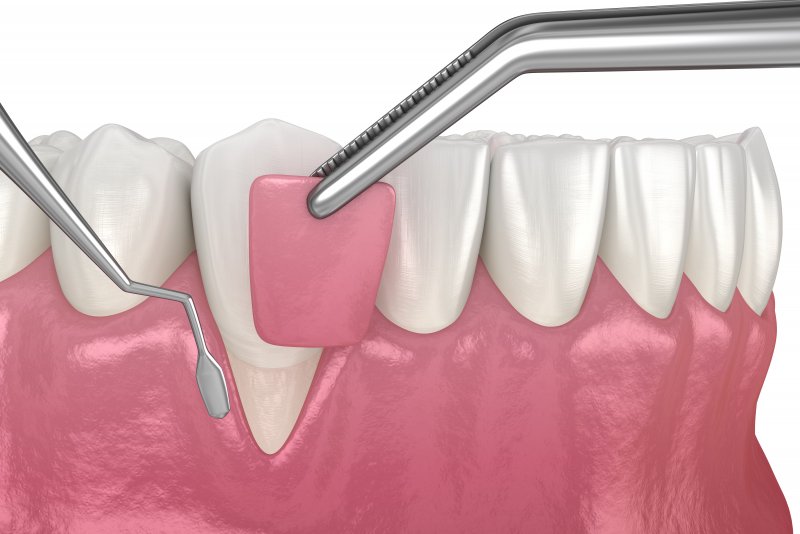 Computer illustration of gum grafting procedure