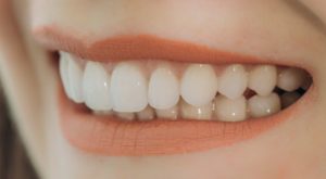 Closeup of beautiful smile after crown lengthening in Huntington Beach