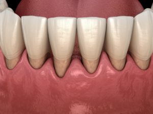 Exposed tooth roots needing gum grafting