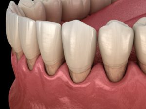 Illustration of receded gums.