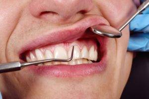 A closeup of a patient’s gums in Huntington Beach