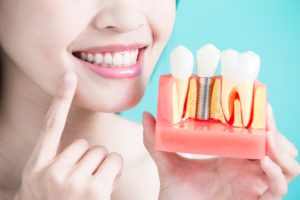 A patient holding a model of dental implants in Huntington Beach