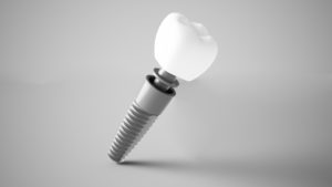 Single-tooth dental implant