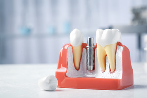 Model of a dental implant and natural teeth
