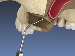 Illustration of sinus augmentation being performed