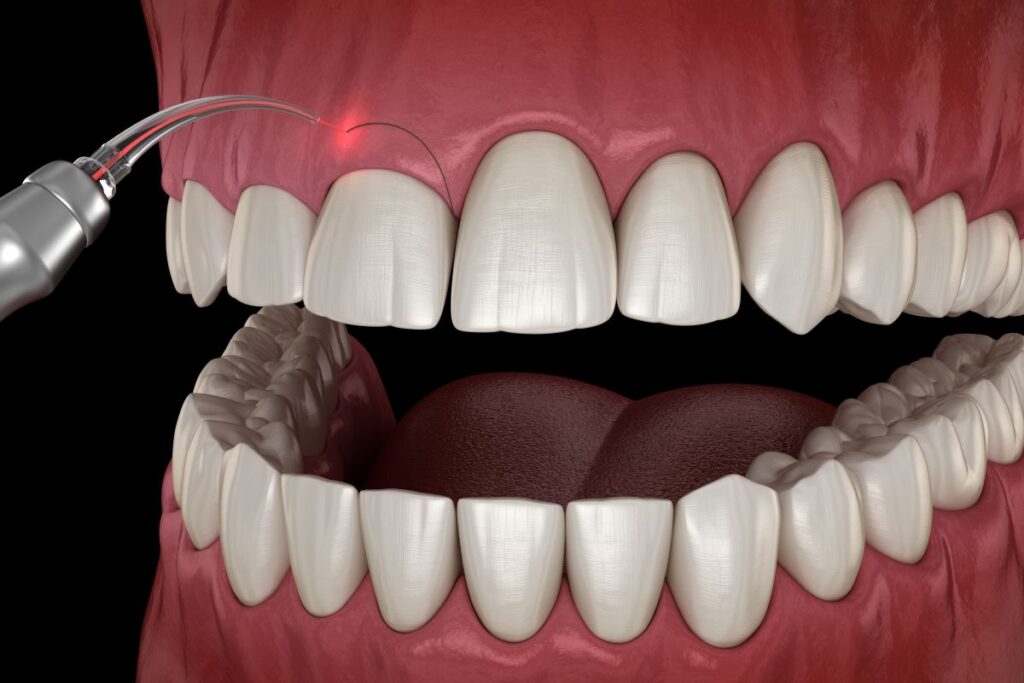 A cgi image of a crown lengthening procedure